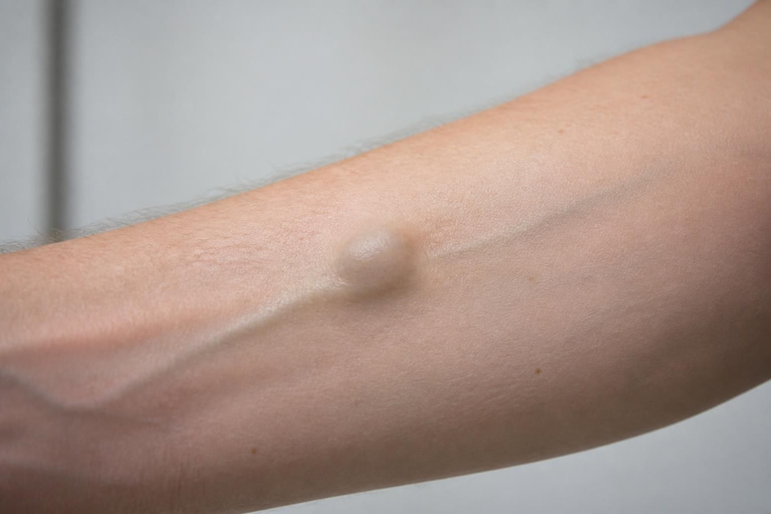 Boule dans une veine du bras : causes possibles et quand consulter un médecin