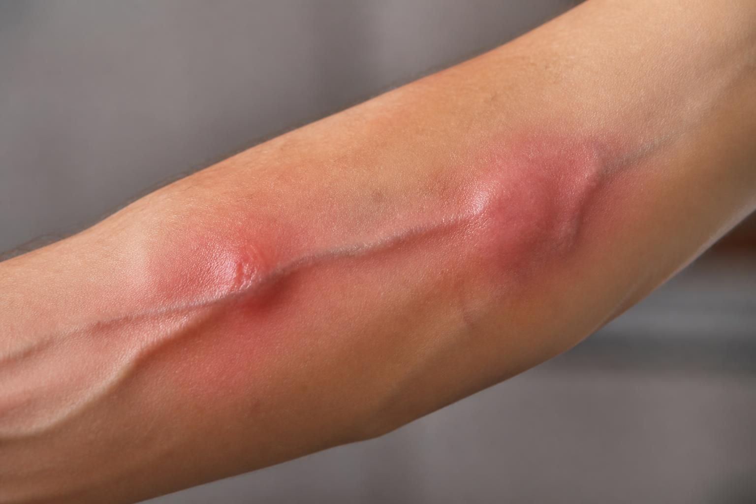 Douleur dans une veine du bras : comment différencier phlébite, irritation ou inflammation ?