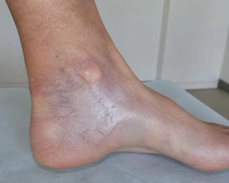 découvrez ce qu’est l’atrophie blanche, une marque cutanée caractéristique de l’insuffisance veineuse avancée, ses causes, ses symptômes et les options de traitement.