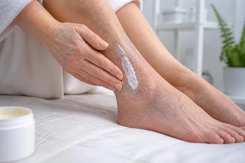 découvrez comment une crème pour dermite ocre peut soulager les symptômes et améliorer la santé de votre peau grâce à un soin local adapté.