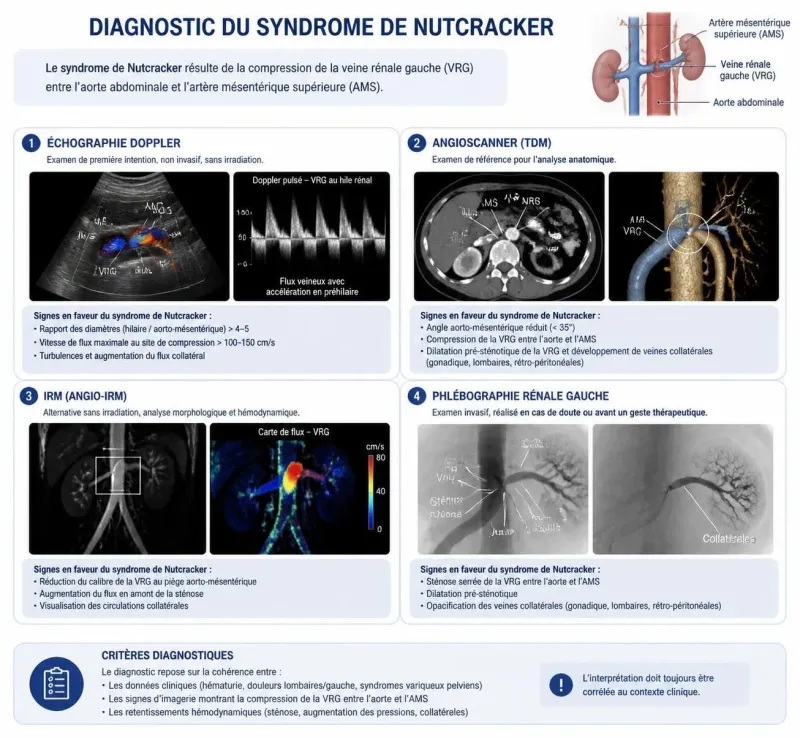 découvrez le syndrome de nutcracker, ses symptômes liés aux douleurs pelviennes et aux veines dilatées, ainsi que les options de diagnostic et de traitement.