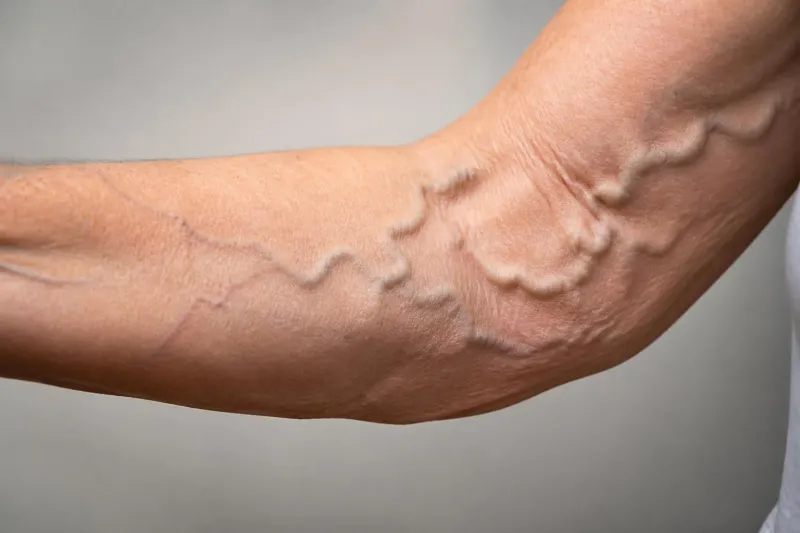 Varices au bras : causes possibles et signes qui doivent faire consulter